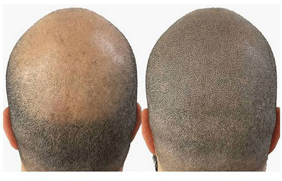 BrowMaster Launches Scalp Micropigmentation services and training courses in India